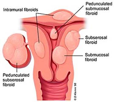 Fibroids1