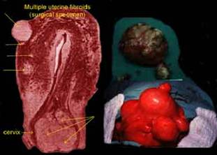 Fibroids1