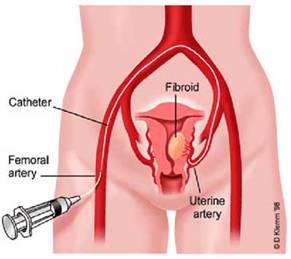 Fibroids3