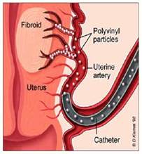 Fibroids4